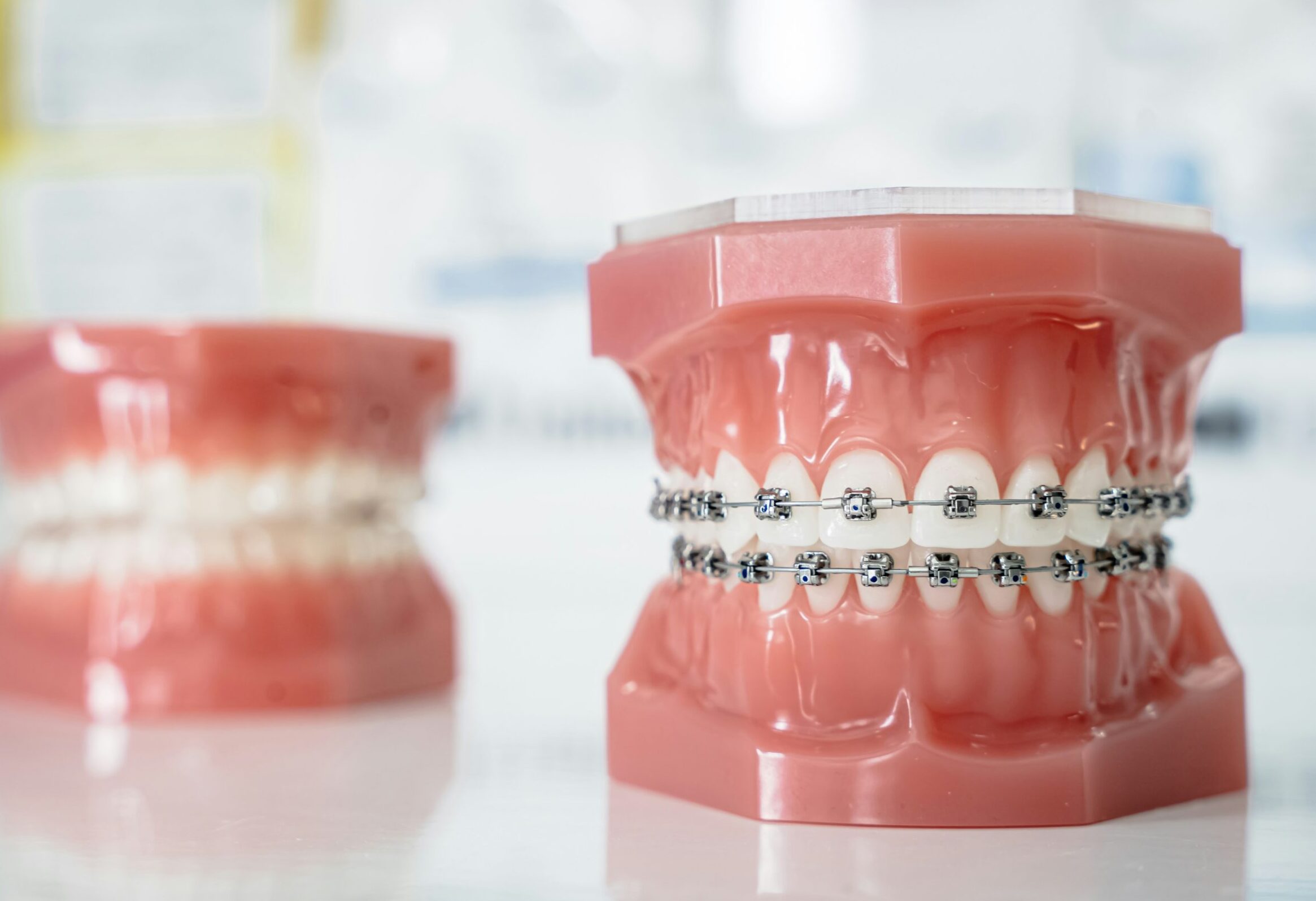 Sonrisa perfectamente alineada con ortodoncia - Brackets metálicos - GL Dent Rancagua